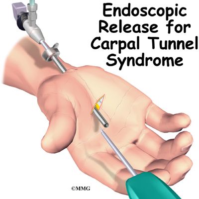 Carpal Tunnel Syndrome - eOrthopod.com Carpal Tunnel Surgery Recovery, Carpal Tunnel Exercises, Carpal Tunnel Surgery, Carpal Tunnel Relief, Ulnar Nerve, Median Nerve, Nerve Health, Muscle Atrophy, Health Disease