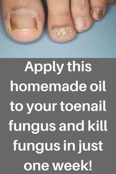 Fungal Nail Infections Toenail Fungal Infection, Nail Remedies, Fingernail Fungus, Toenail Fungus Remedies, Nail Fungus Remedy, Nail Infection, Homemade Oil, Fungal Nail, Ingrown Toe Nail