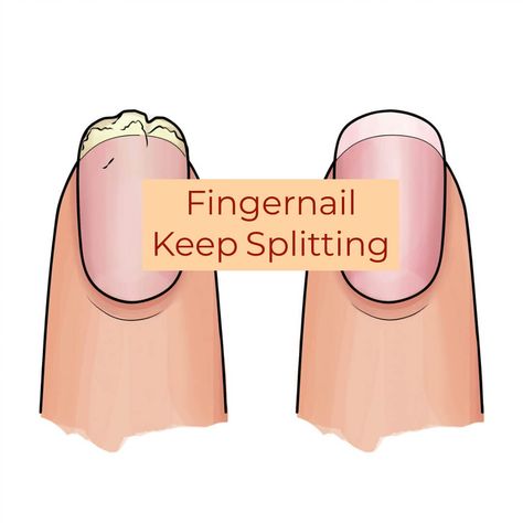 Fingernails Keep Splitting? Here's What To Do - Get Long Nails Nail Splitting Remedies, How To Stop Nails From Splitting, Split Fingernails Remedies, Hang Nail Remedy, Split Nails Remedies, Splitting Nails Remedies, Nail Hardener Diy, Nail Splitting Down The Middle, How To Fix Split Nails