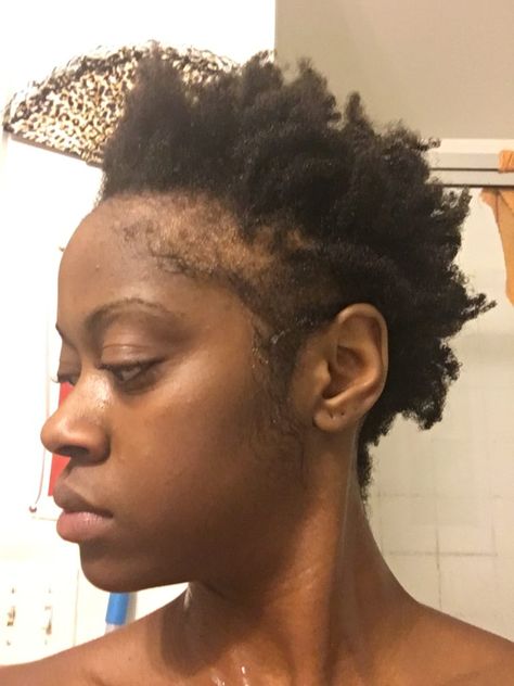 Bald Sides Hairstyles Black Women, Hairstyle For Balding Woman, Hairstyles For Black Women With Alopecia, Bald Baddie Black Women, Bald Edges Hairstyles Black Women, Traction Alopecia Regrowth, Bald Women Black, Traction Alopecia Hairstyles, Androgenic Alopecia In Women