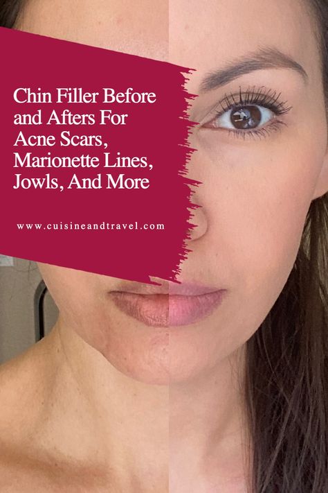 Filler For Jowls, Filler For Marionette Lines, Marionette Lines Before And After, Chin Fillers Before After, Marionette Lines Filler, Chin Wrinkles, Restylane Lyft, Chin Filler, Chin Augmentation