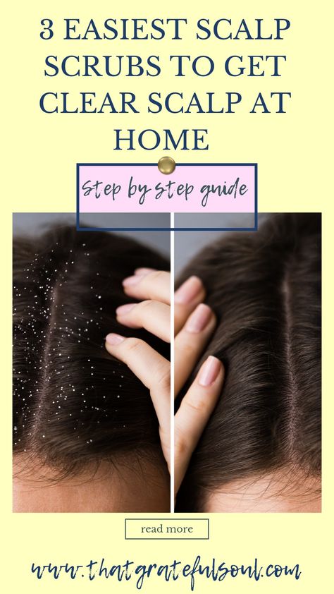 Here are Easy and best diy scalp scrub,diy scalp scrub for buildup,for hair growth, for dandruff hair growth, for itchy scalp,for dry scalp,diy scalp scrub oily hair,diy scalp scrub recipes, for psoriasis. #haircare #diy #homeremedies Clean Scalp Build Up Diy, Diy Hair Scrub For Dandruff, Clean Scalp Diy, Diy Scalp Scrub For Buildup And Dandruff, Diy Scalp Scrub For Itchy Scalp, Natural Remedies For Dry Scalp, Diy Scalp Scrub For Dandruff, Scalp Scrub Dandruff, Diy Scalp Mask