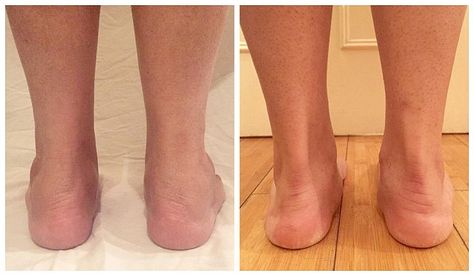 Tone Legs Before And After, Legs Before And After Toned, How To Make Your Feet Slim, How To Get Rid Of Cankles Work Outs Leg Workouts, Slim Down Legs Before And After, Fat Legs Before And After, Cankles Workout Ankle Exercises, Running Legs Before And After, Cankles Workout Before And After