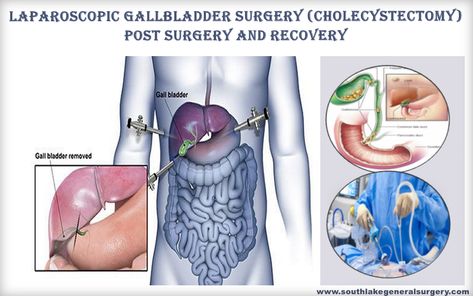 Gallbladder post-surgery effects and recovery can be daunting to navigate. The key to success is to understand the potential side effects and possible complications that can occur. Let's explore more: https://www.southlakegeneralsurgery.com/gallbladder-post-surgery-effects-and-recovery/ Post Gallbladder Surgery Recovery, Gallbladder Surgery Recovery Tips, Biliary Dyskinesia, Gallbladder Diet After Surgery, Gallbladder Removal Recovery, Gallbladder Recovery, Post Gallbladder Surgery Diet, Gallbladder Surgery Diet, Gallbladder Removal Diet