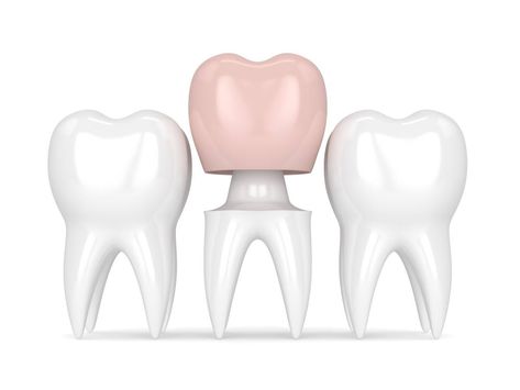 Crown Teeth, Teeth Crown, Decayed Tooth, Tooth Crown, Tooth Repair, Dental Restoration, Dental Aesthetics, Dental Implant Surgery, Dental Fun