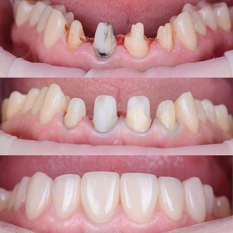 DENTISTRY SCIENCE on Instagram‎: "Build up - 3M Fiber Post+Bulk Fill. Ceramic crowns e.max. . By @stomatolog_31 . . . * ・・・ #dxb #dubai #dental_clinic #cosmeticdentistry #dentoart_worldwide #dentalphotography #luxury #esthetician #compositeveneers #hollywoodsmile #cosmeticdentistry #veneers #directcomposite #dentalart #dentistryworld #dentistrylove #dentaloffice #dentistica #dentalphotography #dentaltechnician #dentalhygienist #dentisteylife #composite #compositeveneers ‏#smiledesign #c Luxury Esthetician, Dental Crown Procedure, Dental Ceramics, Esthetic Dentistry, Dental Posts, Dental Aesthetics, Dental Photography, Dental Anatomy, Dental Implants Cost