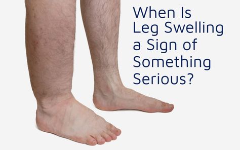 Sitting Too Long, Weak Ankles, Leg Swelling, Swollen Knee, Sunburn Relief, Swollen Ankles, Swollen Legs, Fluid Retention, Healthy Advice