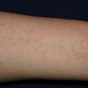 Scabies: The Seven-Year-Itch Skin Rashes Pictures, Remove Skin Tags Naturally, Itchy Rash, Bed Bug Bites, Bed Bug, Bug Bites, Skin Disorders, Skin Allergies, Muslimah Aesthetic