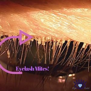 Nearly every single person has small mites living in the skin of their eyelids. Click here to learn more about eyelash mites Itchy Eyelids, Scalp Remedies, Advanced Workout Plan, Dust Mite Allergy, Dry Eye Symptoms, Skin Care Solutions, Dry Eyes, Dust Mites, Single Person