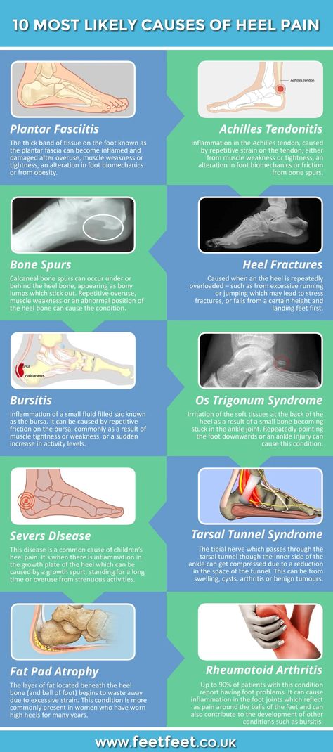 10 Most Likely Causes of Heel Pain | Symptoms and Treatments — Feet&Feet Foot Pain Chart, Heel Pain Relief, Ankle Pain, Health Yoga, Medical Dental, Body Anatomy, Medical Health, Heel Pain, Homemade Remedies