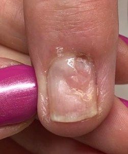 Pterygium - NailKnowledge Nail Disorders, Sjogrens Syndrome, Nail Bed, Nail Plate, Nail Technician, Matrix, Manicure, Read More, Nail Polish