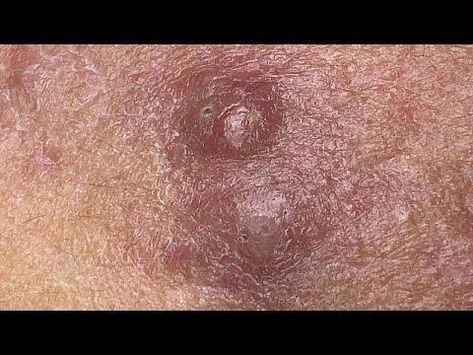 Boil Popping Videos, Hard Pimple, Squeezing Zits, Spa Video, Blackheads Removal Cream, Sac Dep Spa, Nose Pimples, Squeezing Blackheads, Pimple Extraction