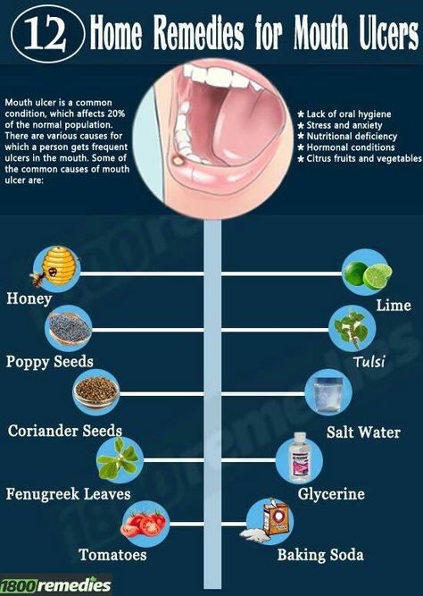 Vitamins Chart, Illness Remedies, Ulcer Remedies Mouth, Canker Sore Remedy, Mouth Ulcer, Remedies For Dry Mouth, Most Delicious Food, Healthy Mouth, Canker Sore