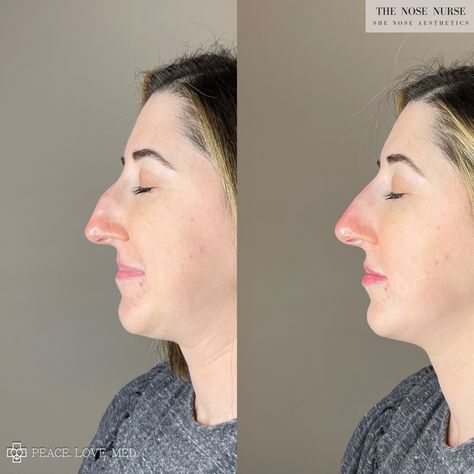 Facial balancing results achieved by strategically placing hyaluronic acid based dermal filler! INSTAGRAM: ig-@thenosenurse ig-@peacelovemedspa 💉💉 📲 Book online at PEACELOVEMED.COM or Call us at (561) 270-5832 #facialbalancing #medspa #bocaraton #miznerpark #floridamedspa #dermalfiller #fillers #balance #botox #lipfiller #filler #nonsurgicalnosejob #cheekfiller #chinfiller #peacelovemed #peacelovemedspa #beforeandafters Facial Balancing, Nonsurgical Nose Job, Filler Instagram, Chin Filler, Boutique Aesthetic, Cheek Fillers, Best Aesthetic, Book Appointment, Dermal Fillers