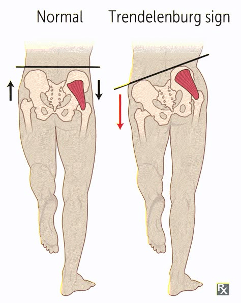 Gluteus Medius Exercises, Hip Strengthening Exercises, Glute Medius, Knock Knees, Lower Back Pain Exercises, Gluteus Medius, Posture Exercises, Knee Exercises, Hip Muscles