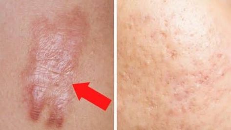 Get Rid Of Scars, How To Heal Burns, Getting Rid Of Scars, Hypertrophic Scars, Manuka Oil, Helichrysum Essential Oil, Art Of Healing, How To Fade, Vetiver Oil