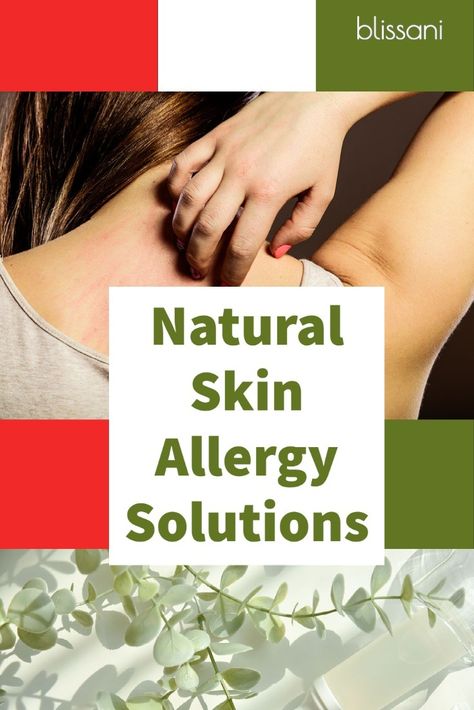 Sun Allergy Remedies, Allergic Reaction Remedies, Allergic Reaction Rash, Sun Allergy, Home Remedies For Allergies, Summer Fun Ideas, Natural Remedies For Migraines, Natural Oils For Skin, Home Remedies For Skin