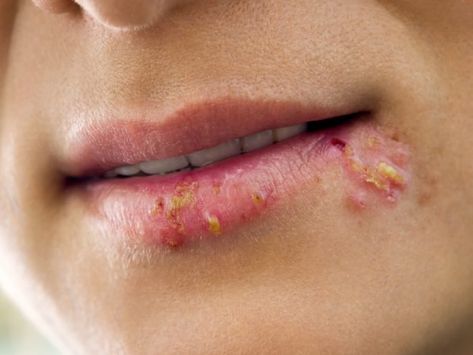 10 Best Essential Oils for Cold Sores | Organic Facts Cold Sore Essential Oil, Oregano Oil Benefits, Essential Oils For Colds, Canker Sore, Coconut Health Benefits, Oregano Oil, Cold Sores Remedies, Clove Oil, Benefits Of Coconut Oil