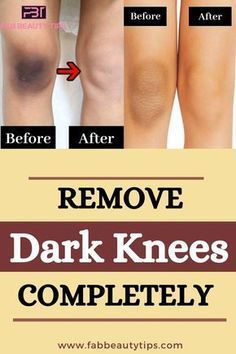 Black Knees How To Get Rid Of, How To Get Rid Of Black Knees, Knee Black Removal, Dark Knees Remedy Fast, Knee Whitening Remedies, How To Remove Dark Knees, How To Get Rid Of Dark Knees, Dark Knees Remedy, Remedies For Dark Knees