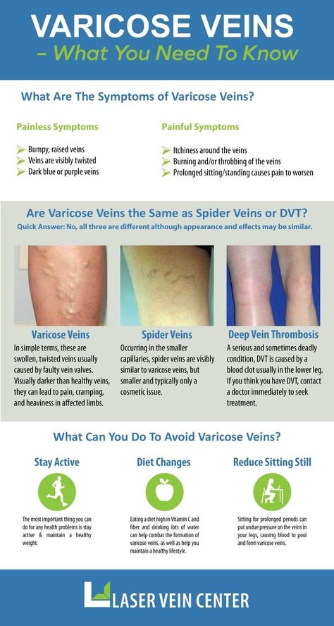 Varicose Veins What YOU NEED TO KNOW. Varicose and Spider Veins explained. The symptoms of varicose veins explained. Descriptions of varicose and spider veins given with pictures. DVT explained with a picture. Preventative measures explained. Vericous Veins, Home Remedies For Spiders, Varicose Vein Remedy, Laser Lipo, Daily Health Tips, Muscle Aches, Good Health Tips, Health Advice, Home Remedies