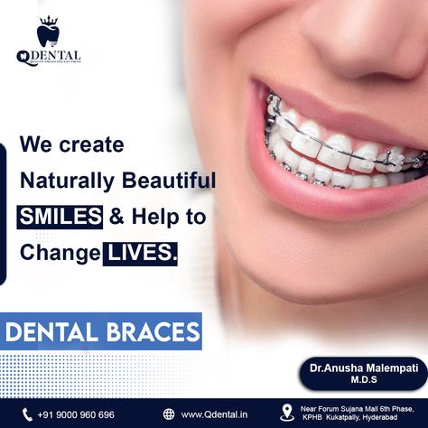 We Create SMILES & Help to change LIVES. DENTAL BRACES 👉 Q Dental is the one-stop solution for all dental problems. 👉 Book Your Appointment Now! 📞 +91 9000 960 696 For more information visit our website: https://qdental.in/ Address: Near Forum Sujana Mall, 6th PHASE, KPHB, Kukatpally, Hyderabad. Maps direction link: https://goo.gl/maps/kyGH7kNaZjS7REpTA WhatsApp: https://wa.link/tre9n6 Follow on us: https://www.instagram.com/qdentalclinickukatpally/ https://www.linkedin.com/in/q-dental Dental Surgeon, Dental Braces, Best Dentist, Dental Problems, Dental Hygienist, Uttar Pradesh, Naturally Beautiful, Dental Implants, Dental Clinic