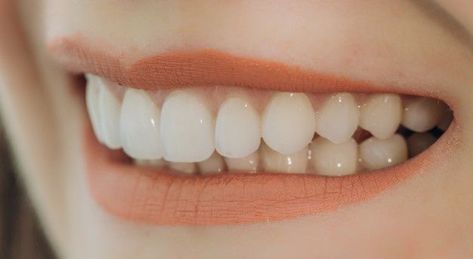 Zoom Teeth Whitening, Logo Dental, Teeth Aesthetic, Pretty Teeth, Beautiful Teeth, Pasta Dental, Perfect Teeth, Dental Veneers, Natural Teeth Whitening