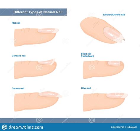 Illustration about Different Types of Fingernail. Normal, Short, Roofed, Tubular, Arched, Flat, Convex and Concave Nails. Nail Extension Guide. Vector Illustration. Illustration of anatomy, curve, growth - 202960790 Flat Nails Shape, Nail Bed Damage, Nail Health Signs, Types Of Nails Shapes, Long Nail Beds, Natural Nail Shapes, Nail Tech School, Artistic Nails, Nail Shapes Square