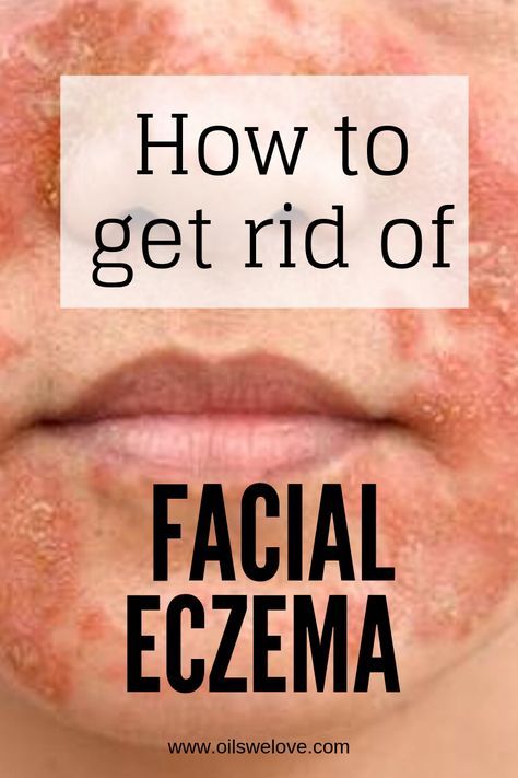 How to get rid of eczema on the face with natural remedies. Up to 40 natural and DIY remedies to get rid of facial eczema. Home Remedies For Face, Severe Dry Skin, I Healed, Home Remedies For Skin, Dry Skin Remedies, Natural Face Skin Care, Home Health Remedies, Diy Remedies, Dry Skin Care