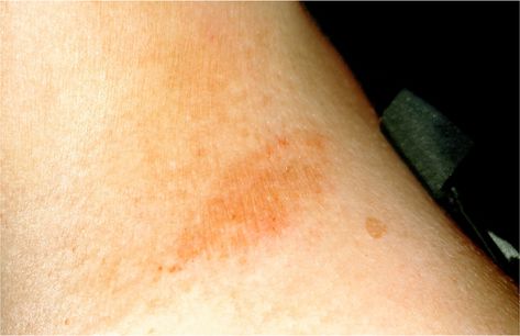 Pigmentation Disorders: Diagnosis and Management | AAFP Pityriasis Alba, Tinea Versicolor, Glycolic Acid Peel, Lip Tips, Post Inflammatory Hyperpigmentation, Intense Pulsed Light, Chemical Peels, Laser Therapy, Chemical Peel