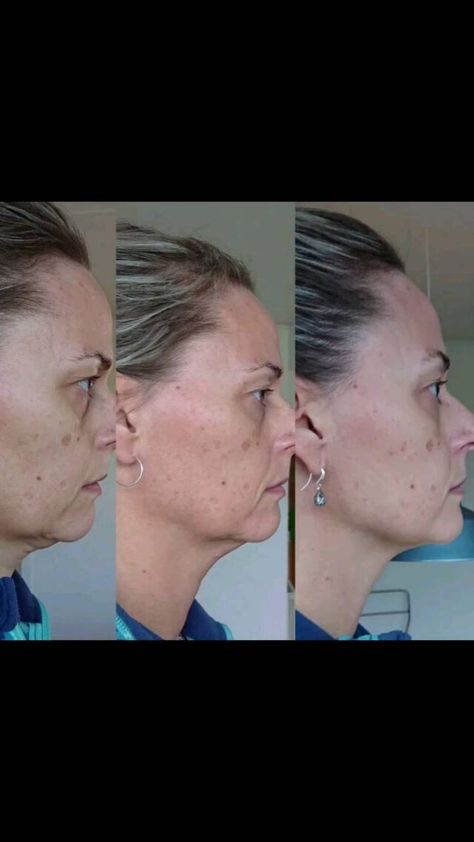 Jowl Exercises, Sagging Skin Face, Sagging Jowls, Sagging Cheeks, Sagging Face, Face Yoga Method, Sagging Neck, Face Yoga Exercises, Facial Yoga