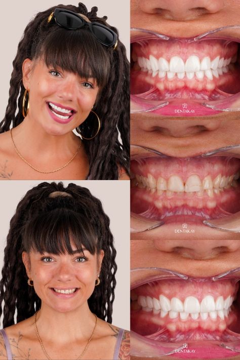 If you’re interested in getting a set of perfect teeth, here are some of the 3 top procedures you can consider.  But beyond this, we’ll also discuss why it matters to have perfect teeth as well as the factors that go into the process of defining an ideal smile. Hollywood Smile, Perfect Teeth, Smile Makeover, Easy Steps, Easy Step, The 3, Hollywood, Quick Saves