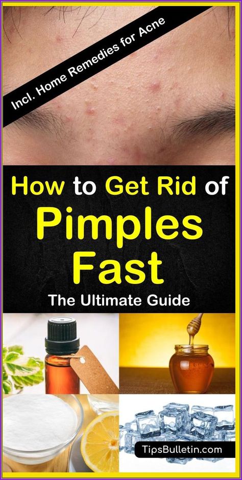 Pimple Remedies, Get Rid Of Pimples Overnight, Rid Of Pimples Overnight, Home Remedies For Pimples, Get Rid Of Pimples, Rid Of Pimples, Pimples Overnight, Pimples Remedies, Home Remedies For Acne