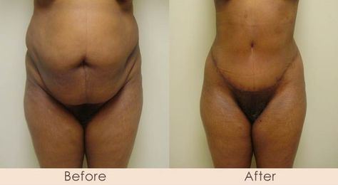 Tummy Tuck Tummy Tucks Before And After, Mommy Tummy, Tight Tummy, Mommy Makeover, Work Tips, New You, Plastic Surgery, Surgery, Michigan