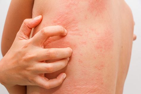 High Histamine Foods, Mast Cell Activation Syndrome, Tomato Nutrition, Zinc Deficiency, Mast Cell, Skin Allergies, Insect Bites, Poison Ivy, Home Remedies