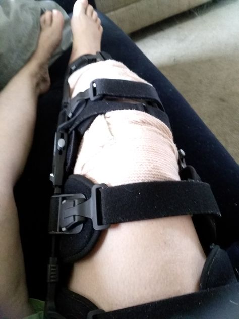 Mar 28 started out like any other day. Little did I know how much my life would change. I would come home from the hospital with a #TibularPlateauFracture. A injury that is apparently very rare &so I want to share my journey in hopes of helping others. Knee Fracture, Fridge Photos, Leg Injury, Broken Leg, Knee Brace, My Coffee, Prince George, Take Me Home, Coping Mechanisms