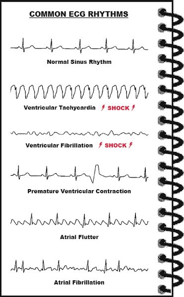 Abnormal ECG rhythms Anesthesia Tech, Ekg Rhythms, Nerdy Nurse, Nurse Notes, Nursing Mnemonics, Medical Student Study, Cardiac Nursing, Nursing School Survival, Respiratory Therapy