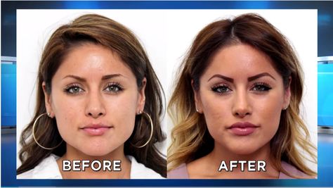 Can Botox® Make A Face Slimmer? - Aesthetic Insider Thinner Face, Face Slimmer, Teeth Clenching, Botulinum Toxin, Plastic Surgery Procedures, Facial Plastic Surgery, Slimmer Face, Facial Plastic, Medical Aesthetic