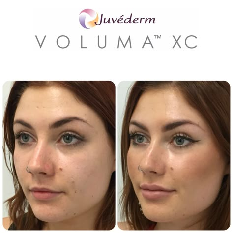 Slightly higher cheekbones? Yes, it might look better | Revitta Cosmetic Clinic | Manhattan and Brooklyn | 212.535.1201 | revitta.com/ | #newyork #beauty #cheeks #cheekbones #juvederm #voluma #radiesse #filler #cosmetic #look #style #gorgeous #face #faceinjection #dermafiller #cute #followme #tagforlikes #love #instadaily #instamood #photooftheday #picoftheday #instalike #cool #igdaily #instafollow #newyorkbeauty #newyorker #newyorkmodel Voluma Cheeks, Juvederm Lips, Derma Fillers, Cheek Fillers, Facial Fillers, Character Change, Cosmetic Clinic, Facial Aesthetics, Lip Enhancement