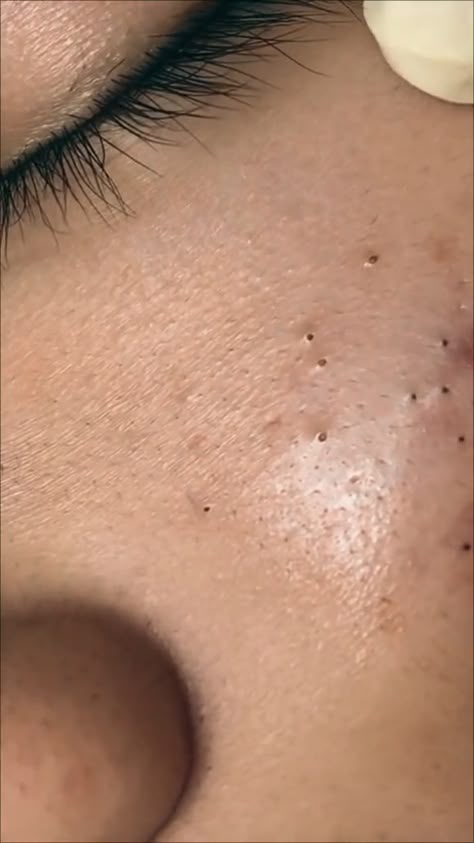 "Get ready to indulge in the ultimate pimple popping satisfaction! Watch as skilled dermatologists perform unbelievably satisfying extractions, from blackheads and whiteheads to cysts and everything in between. Perfect for pimple popping enthusiasts, these videos provide a mesmerizing and oddly soothing experience that you won't be able to look away from. Subscribe now for a regular dose of your favorite skincare guilty pleasure!" Black Heads On Nose, Removing Blackheads From Nose Videos, Blackheads Removal Satisfying Videos, Blackheads On Back, Blackheads Nose, Head Pimples, Black Head Removal, Ear Pimple, Squeezing Blackheads