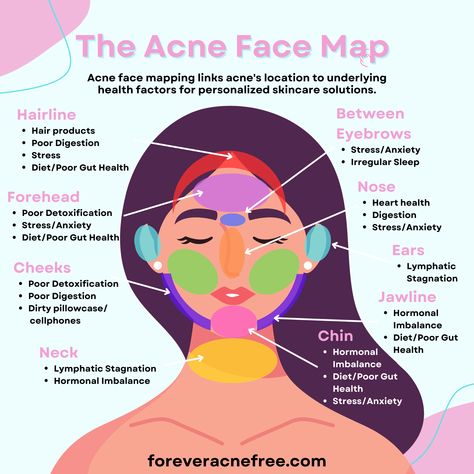 The Acne Face Map, Acne Face Mapping, What Your Breakouts Mean, Acne Solutions ; Opens a new tab Face Map Acne, Pimple Meaning, Acne Face Mapping, Acne Face Map, Face Map, Face Mapping Acne, Pimples On Face, Acne Vulgaris, Skin Advice