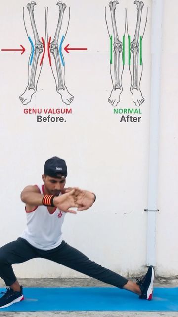 Genu Valgum Exercises, Genu Valgum, Knock Knees, December 7, Leg Workout, Daily Workout, Knock Knock, Fitness Tips, At Home Workouts