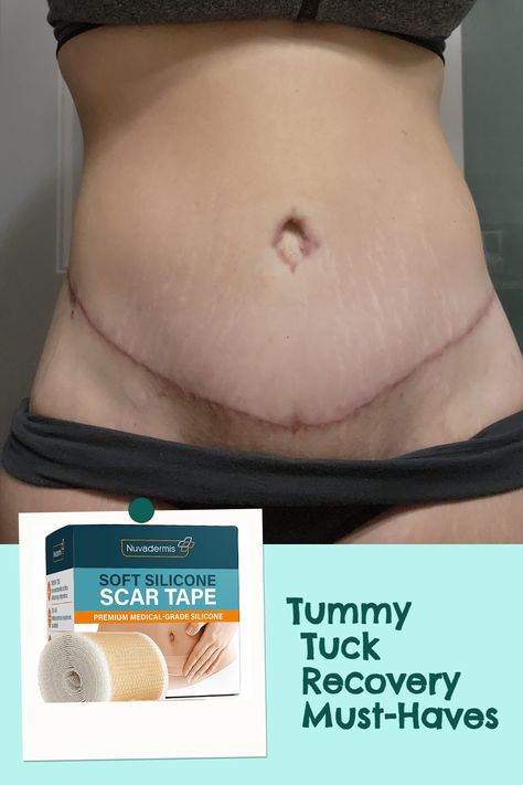 Ready to bounce back after your tummy tuck?👩‍👩‍👧‍👦 Discover the top recovery essentials you absolutely need to make the process more comfortable and stress-free. Check out our comprehensive list now!🎁 Plus Size Tummy Tucks Before And After, Tummy Tucks Recovery List, Tummy Tucks Recovery Tips, Mommy Makeover Recovery, Mommy Makeover Surgery Recovery, Tummy Tucks Recovery, Mommy Makeover Surgery, Tummy Tucker, Amazon List