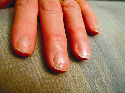 Weakened Nails After Gel Removal Nail Growth Faster, Gel Removal, Nails After Acrylics, Nail Growth Tips, Grow Nails Faster, Food Nails, Weak Nails, Nail Care Routine, How To Grow Nails