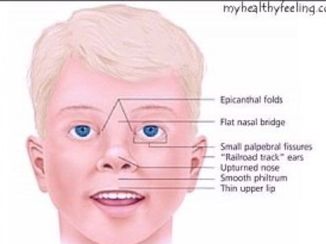 Prader-Willi Syndrome A genetic disorder that causes obesity, intellectual disability, and shortness in height. Prader-Willi syndrome is caused by the loss of function of genes in a particular region of chromosome 15. Foetal Alcohol Syndrome, Digeorge Syndrome, Prader Willi Syndrome, Fetal Alcohol Spectrum Disorder, Fetal Alcohol, Parenting Support, Foster Care Adoption, Build Community, Adoptive Parents