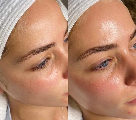 Facials Before And After, Microneedling Before And After, Dermaplaning Before And After, Derma Planing, Hydrafacial Before And After, Facial Before And After, Dermaplaning Facial, Diy Facials, Deep Clean Skin