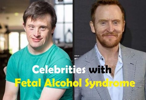 10 Celebrities with Fetal Alcohol Syndrome Foetal Alcohol Syndrome, Tony Curran, Family Reunion Food, Alcohol Pictures, Fetal Alcohol Spectrum Disorder, Fetal Alcohol, Inspiring Stories, News Magazine, Celebrity Kids