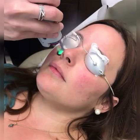 Skin care is one of the most important aspects of preserving one’s appearance.  🥰🥰🥰 #wbo #womensbeautyoffers #beautybllogers #beautyfashion #fashion #fractional #restoringskin #skin #sharplight Profractional Laser, Face Laser, Laser Peel, Acne Laser, Face Treatments, Laser Skin Resurfacing, Fractional Laser, Laser Resurfacing, Skin Resurfacing