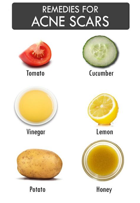 Remedies For Acne, Acne Overnight, Natural Acne Remedies, Natural Acne, Home Remedies For Acne, Acne Scar Removal, Face Products, Acne Remedies, Skin Remedies