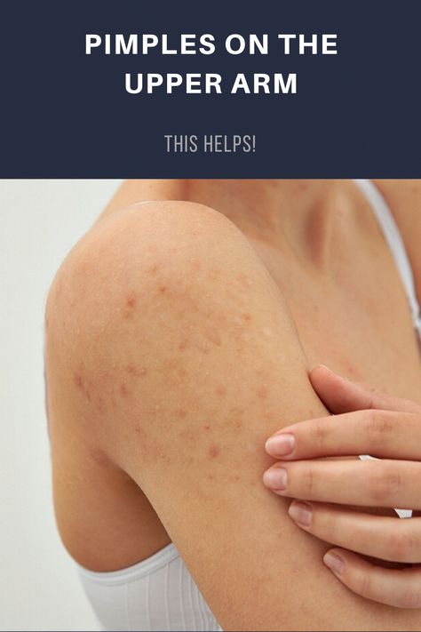 Where did they come from? Pimples on the upper arm may not be a disaster, but they're not welcome either. You can get rid of them that way! Acne On Arms, Remove Skin Tags Naturally, Get Rid Of Pimples, Blind Pimple, Rid Of Pimples, Forehead Acne, Pimples Under The Skin, Prevent Pimples, Underarm Hair Removal