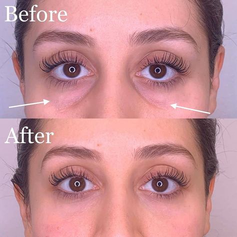 Best of Cosmetic Dermatology on Instagram: “Before/after tear trough filler. Thoughts? Comment ⬇️ . . This procedure was performed by @dr.rebecka.gardell . . Filler can help hide dark…” Filler Under The Eyes, Tear Through Eye Filler, Tear Through Filler Before And After, Eye Trough Filler Before And After, Filler Under Eyes Before And After, Undereye Filler Before And After, Face Fillers Before And After, Tear Trough Filler Before After, Under Eye Filler Before And After